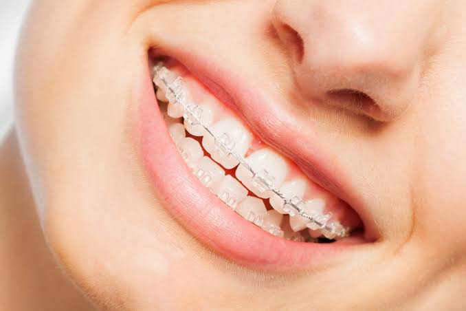 Smil med gjennomsiktige Damon-brackets